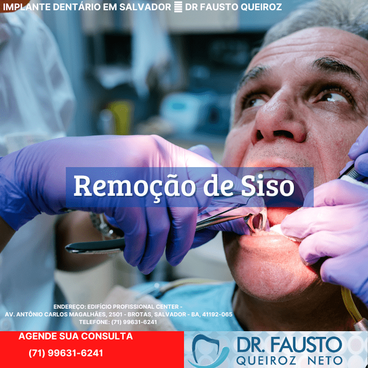 Remoção de Siso em Salvador - Dentista em Salvador - Extração de Siso (1) (1)